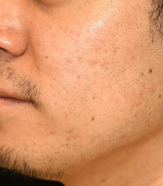 after