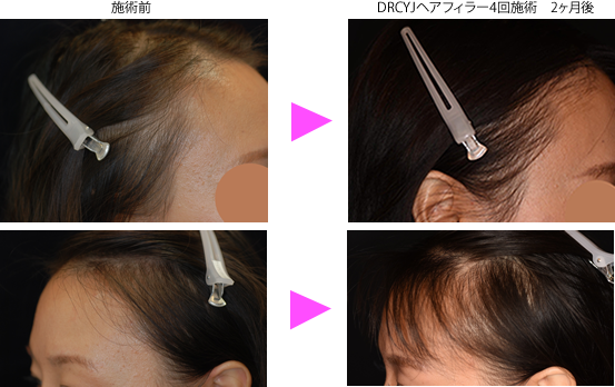 育毛 発毛治療 施術メニュー ア行 銀座ケイスキンクリニック 東京 銀座の美容皮膚科 美容医療 アンチエイジング 若返り