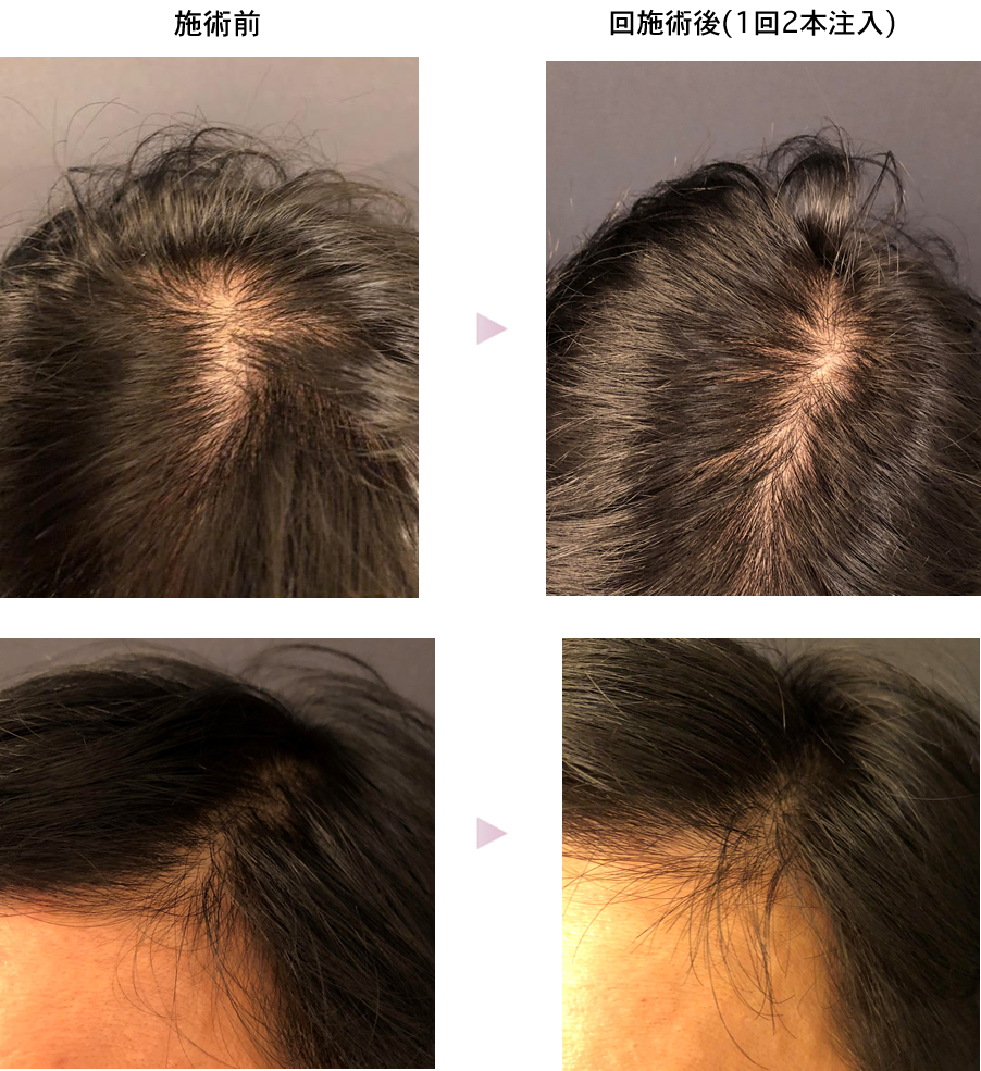 育毛 発毛治療 施術メニュー ア行 銀座ケイスキンクリニック 東京 銀座の美容皮膚科 美容医療 アンチエイジング 若返り