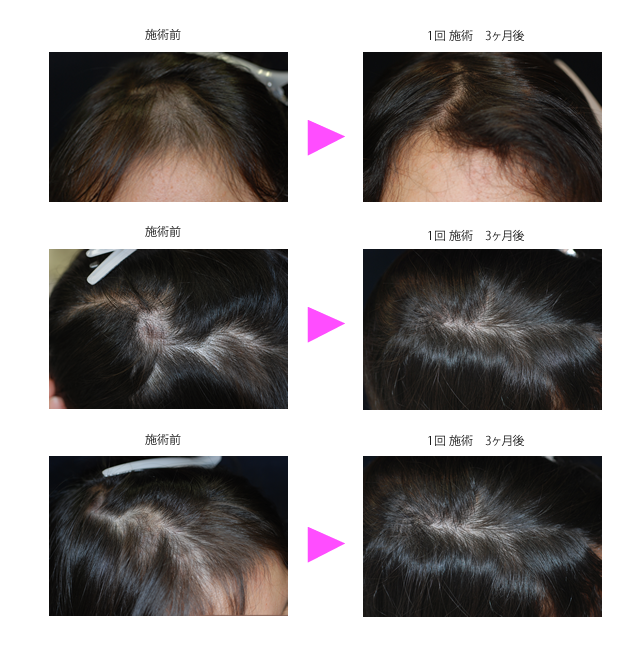 育毛 発毛治療 施術メニュー ア行 銀座ケイスキンクリニック 東京 銀座の美容皮膚科 美容医療 アンチエイジング 若返り
