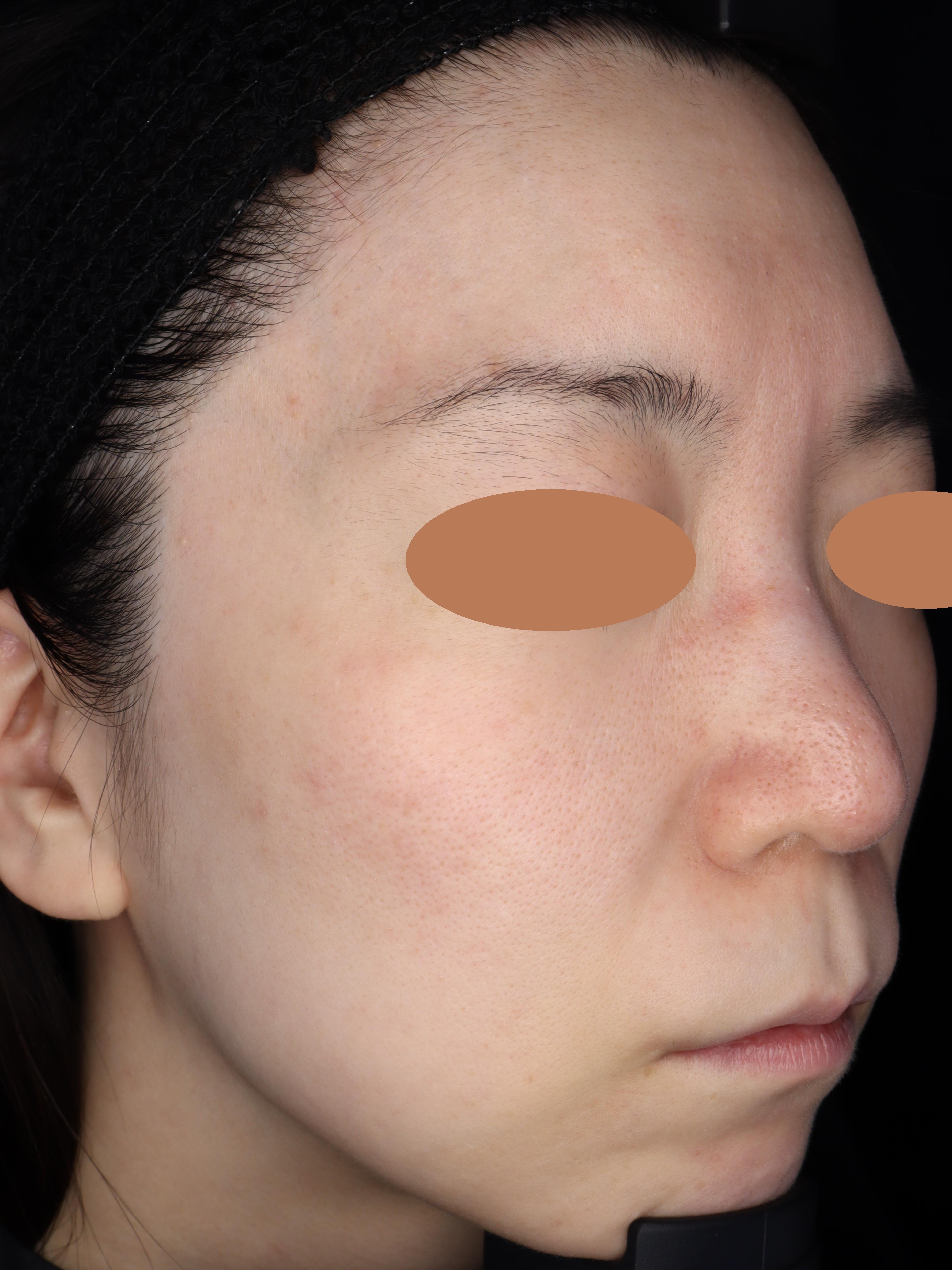 After（アフター）