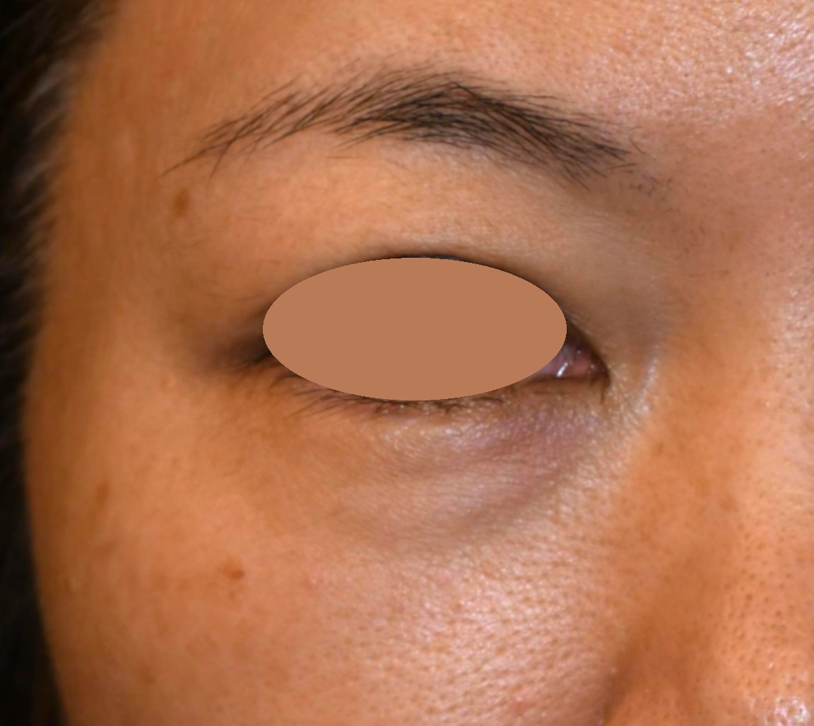 Before（ビフォー）