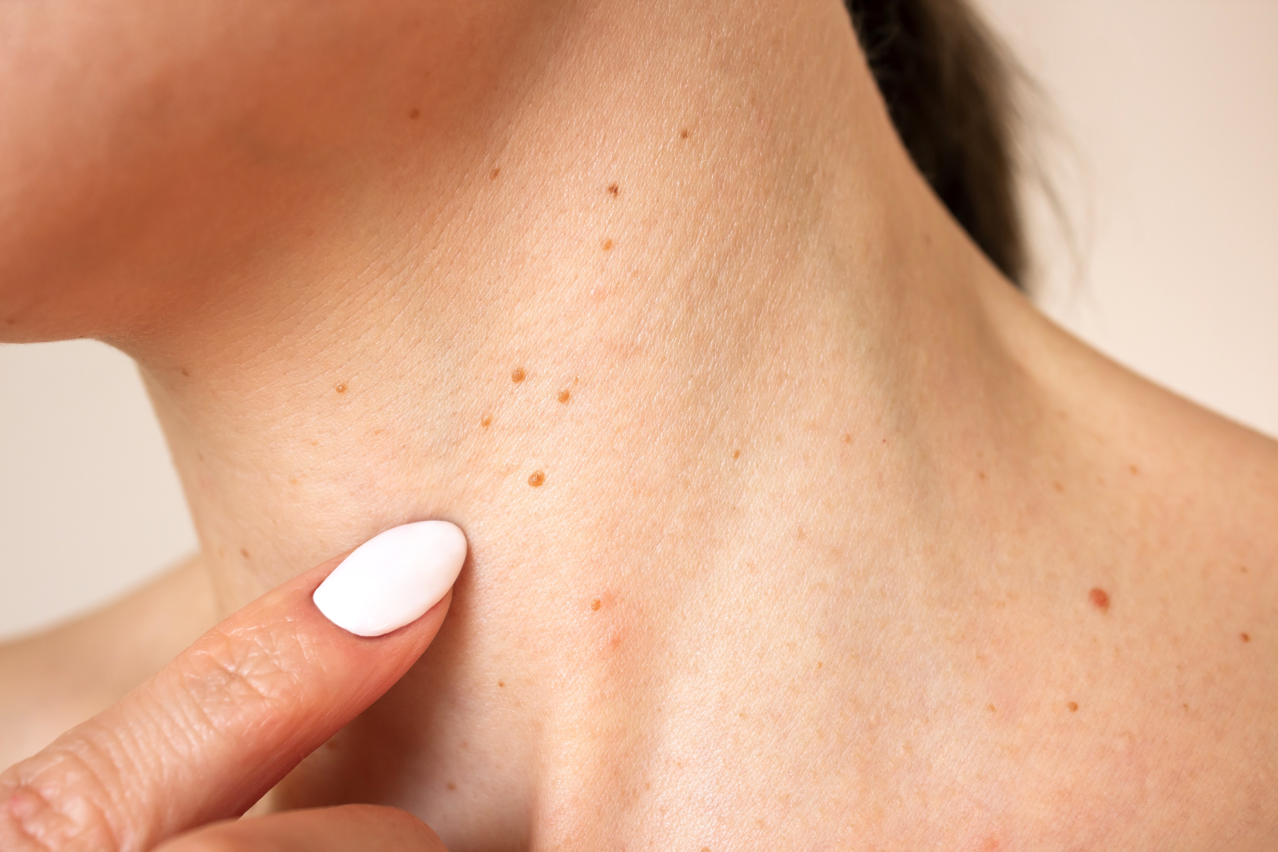 【イボの種類】良性、悪性？加齢、ウィルス性？保険診療と自由診療の治療法の違いなど解説！